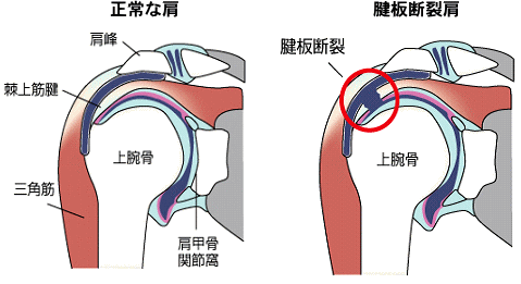 腱板断裂