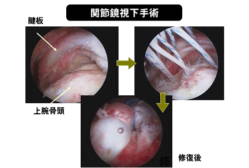 関節鏡視下手術