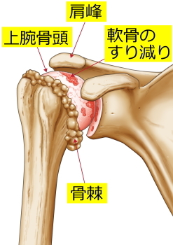 変形性肩関節症