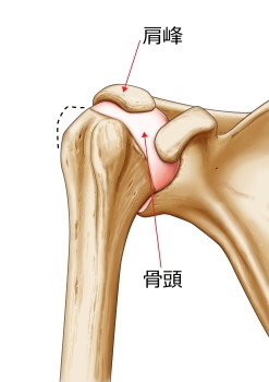 腱板断裂症性変形性肩関節症