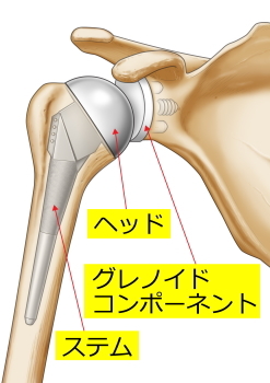 全人工関節置換術