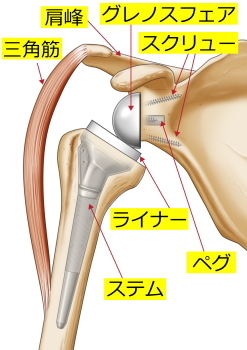 反転型全人工肩関節置換術