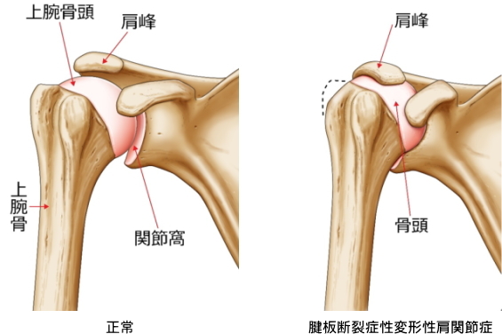 腱板断裂症性変形性肩関節症