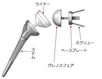 反転型全人工肩関節置換術(リバース型全人工肩関節置換術)
