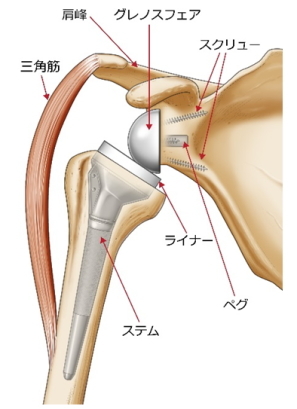 リバース型人工関節が上腕骨と肩甲骨にはいった状態