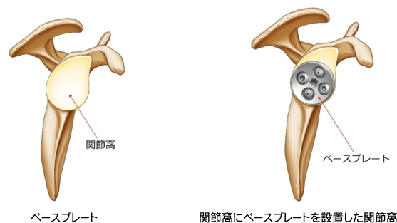 ベースプレートが肩甲骨関節窩に挿入された状態