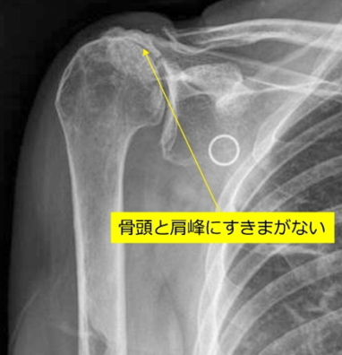 手術前のレントゲン