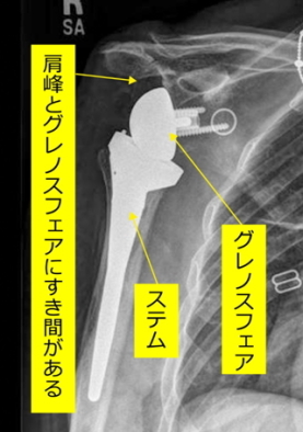 手術後のレントゲン