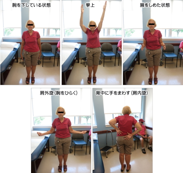 手術後3ヶ月の時点での経過(右肩手術)