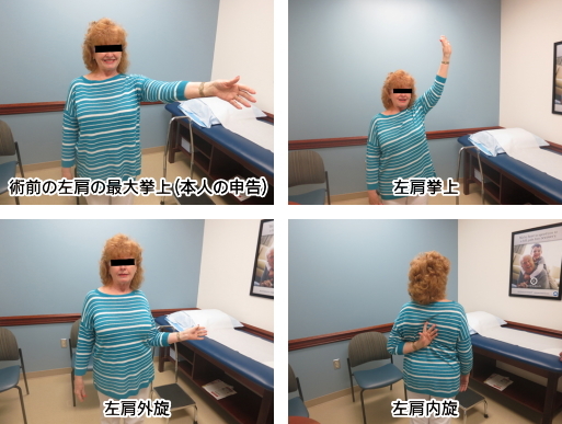 手術後2年の時点での経過(左肩手術)