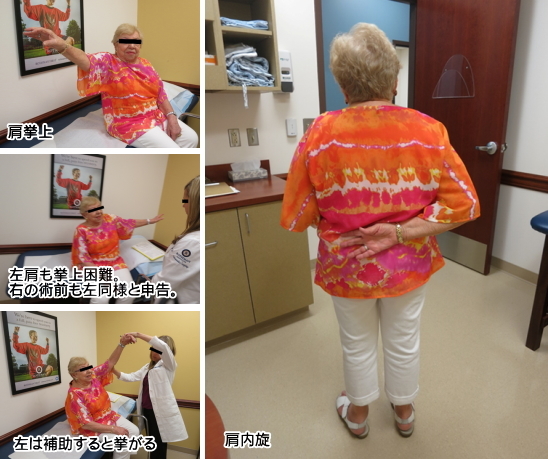 手術後5年の時点での経過(右肩手術)