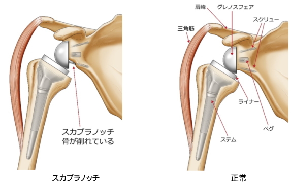 スカプラノッチ