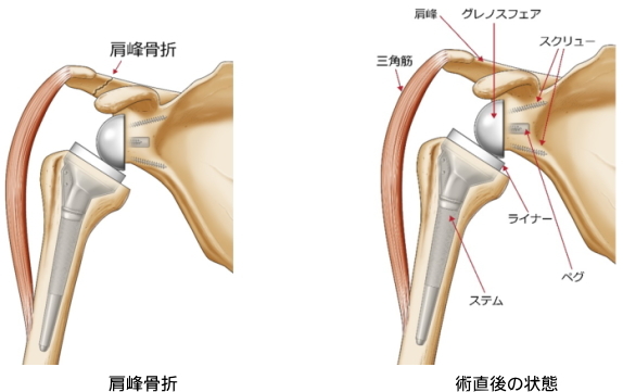 肩の外傷: 骨接合術&人工肩関節置換術その他