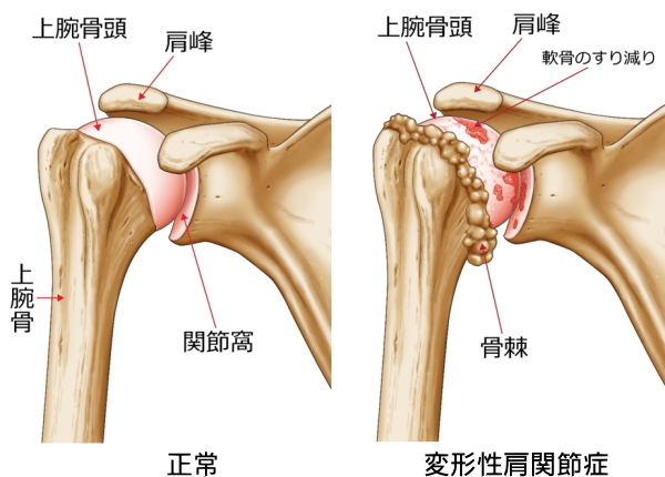 変形性肩関節症