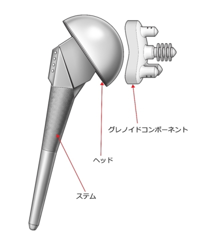人工関節置換術