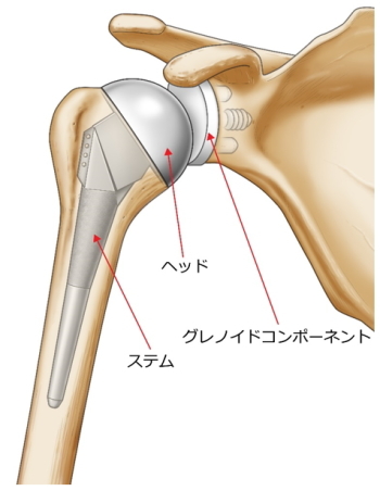 人工関節が上腕骨と肩甲骨にはいった状態