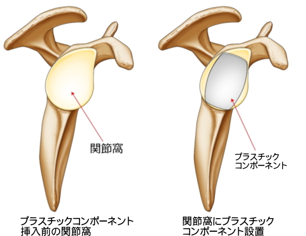 受け皿が肩甲骨関節窩に挿入された状態