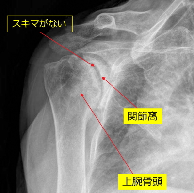 手術前のレントゲン