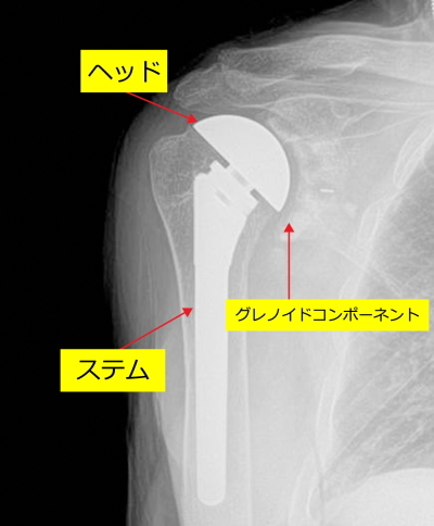 手術後のレントゲン