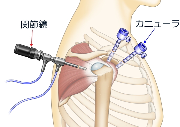 関節鏡手術イラスト