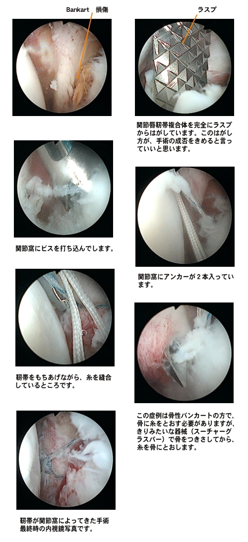 Dual suture法