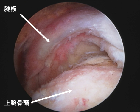 断裂した腱板を関節鏡でみると