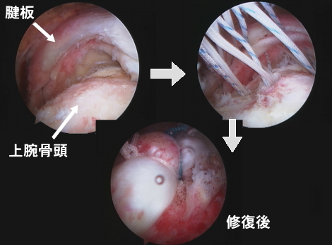関節鏡視手術