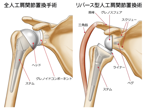 リバース型人工肩関節置換術