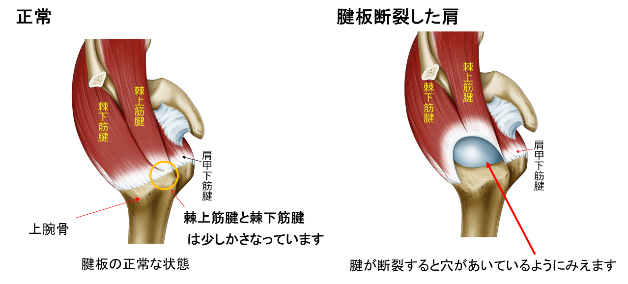 正常の腱板と腱板断裂