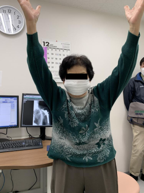 人工関節(リバース型人工関節)