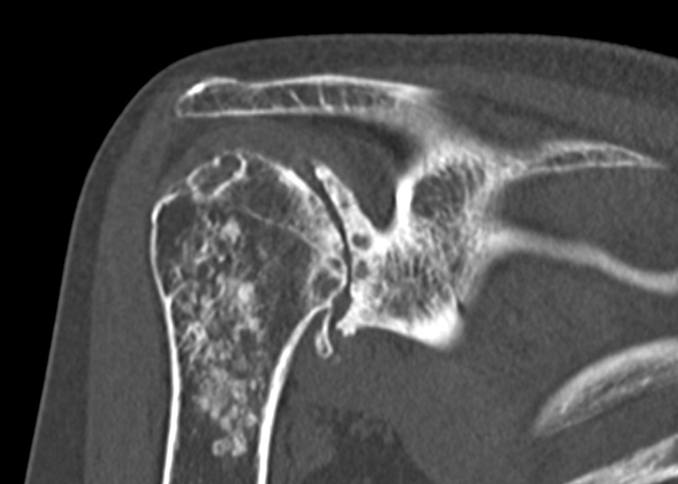 Coronal CT