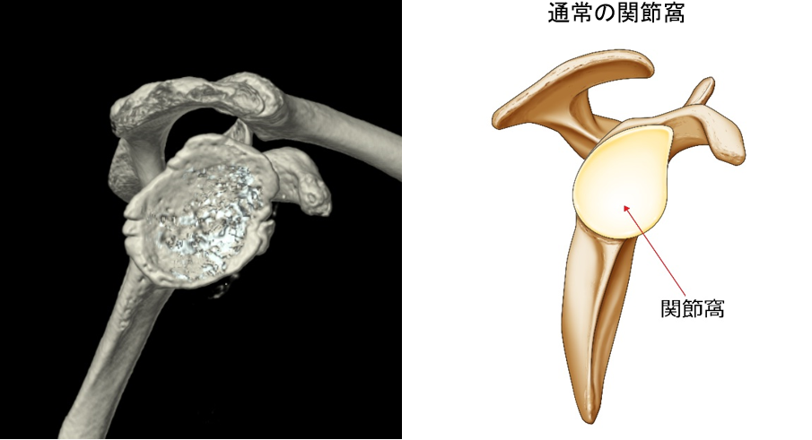 深いお椀のような関節窩