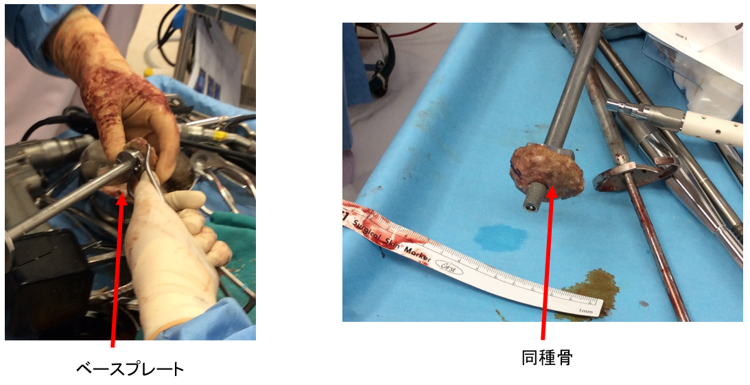 手術時の関節窩