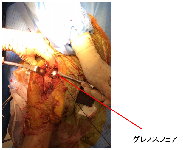 グレノスフェアを装着します