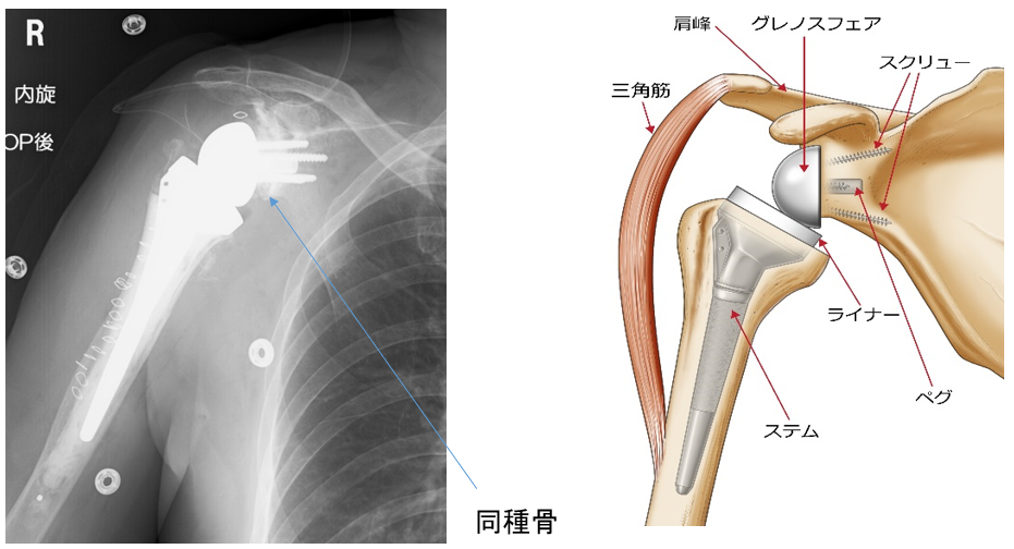 手術直後のレントゲン