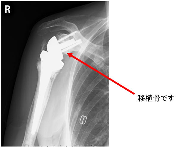 手術後半年でのレントゲン