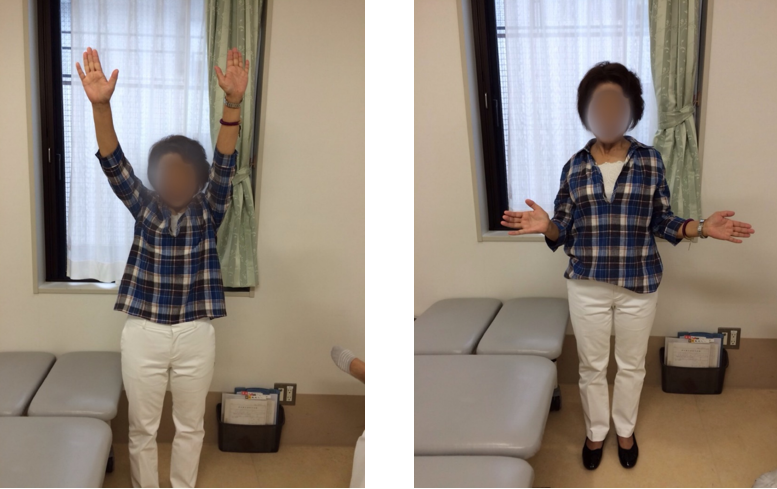 術後1年での肩の動き