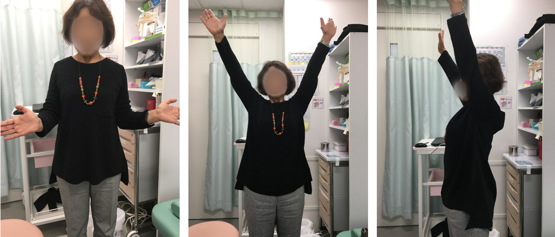 術後6年での肩の動き