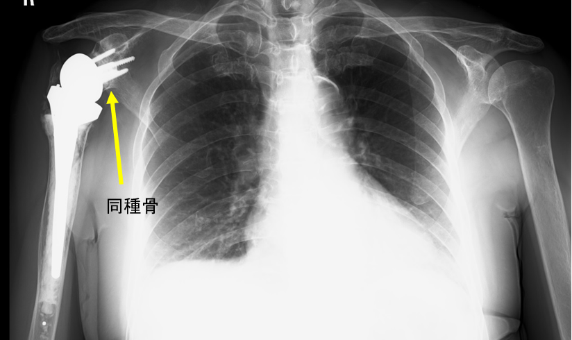 手術して6年でのレントゲン