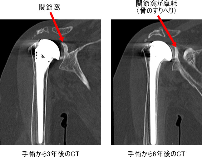 セット 肩関節のMRI 、人工肩関節置換術、肩関節再建術 人工肩関節再置換術|森大祐(京都)
