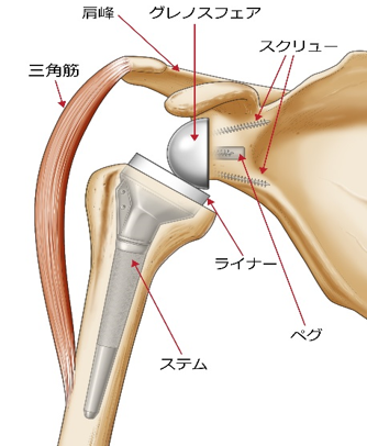 リバース型人工肩関節置換術のインプラント