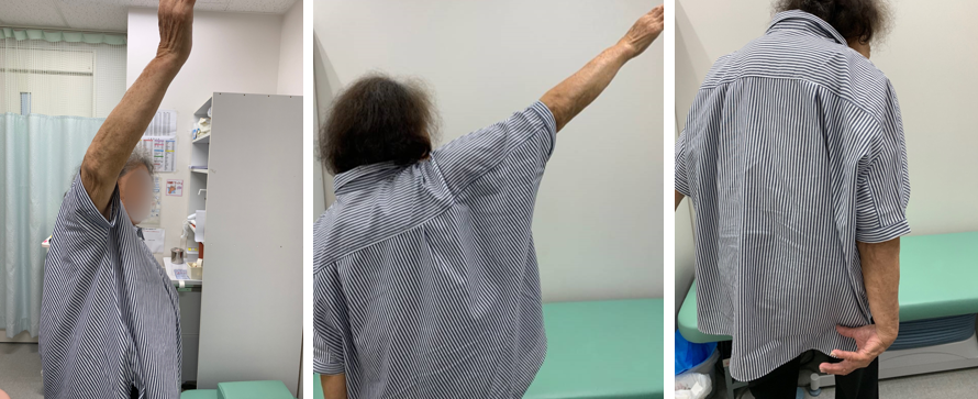 術後1年での動き