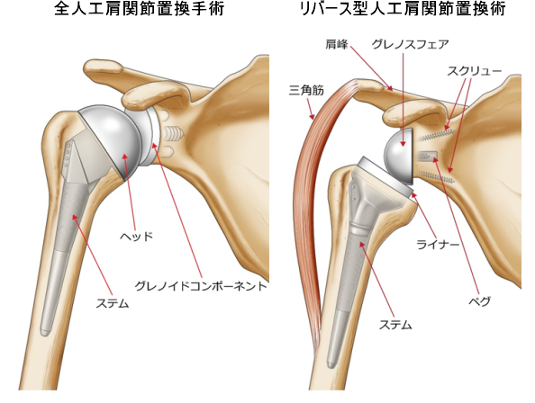 リバース型人工肩関節置換術