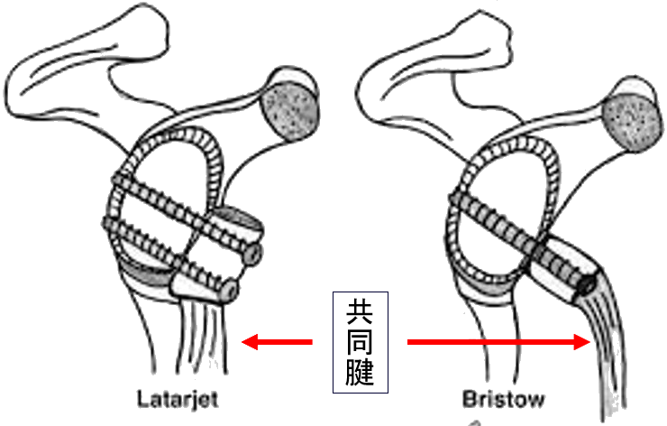 烏口突起移行術​