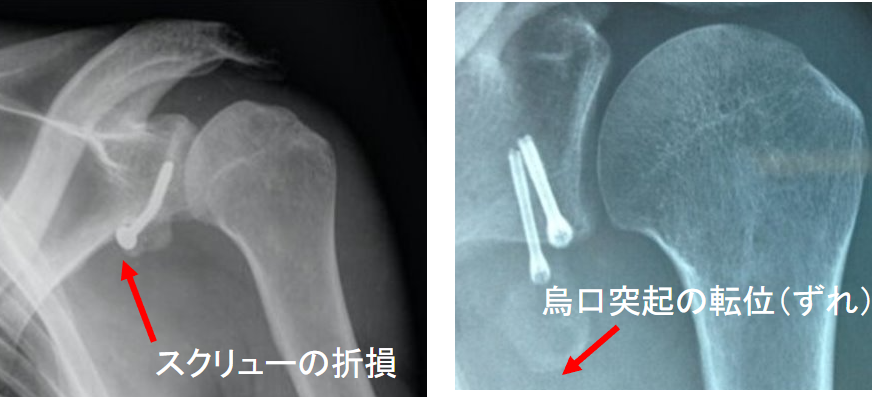 烏口突起移行術の合併症