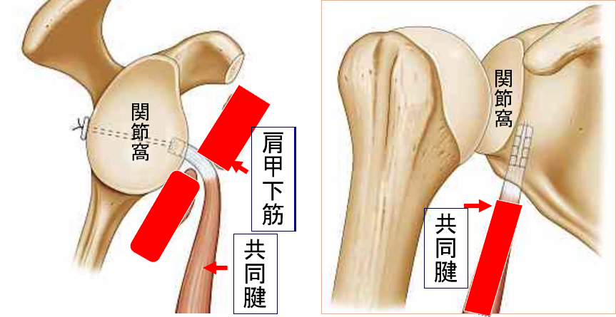 烏口突起共同筋腱移行術​