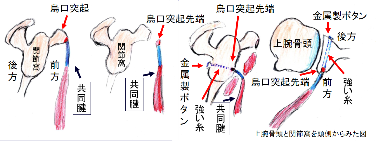 烏口突起共同筋腱移行術​